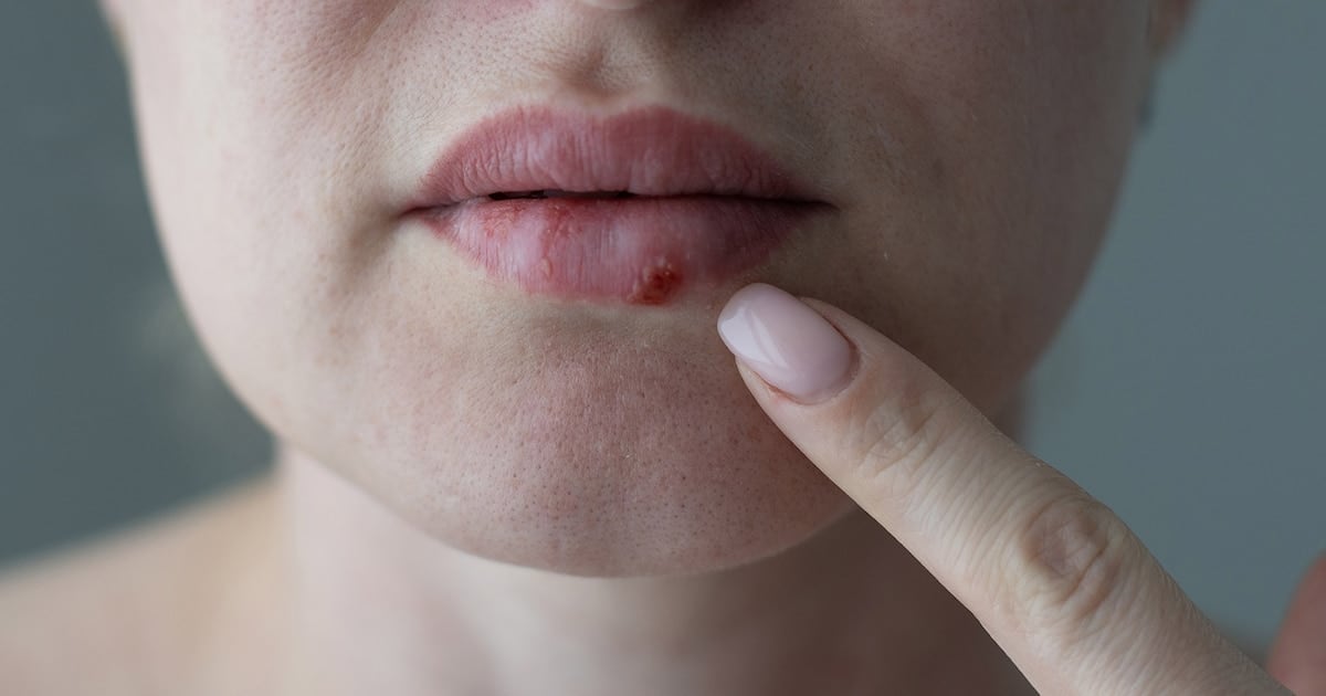 Aprobaron en Estados Unidos un antiviral oral que frena el herpes resistente en pacientes con defensas bajas