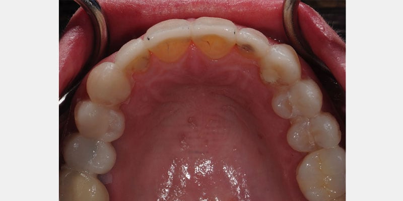 Carillas dentales: las señales de una filtración que avanzan en silencio y cómo actuar a tiempo